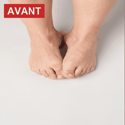 Orteils comprimés vs étalés — avant / après